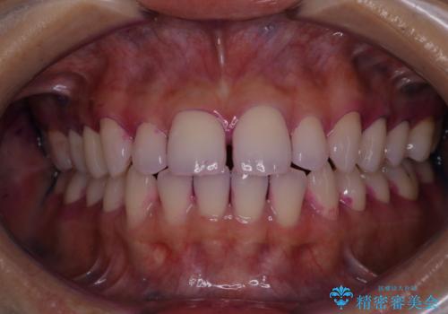 歯科矯正前にPMTCで清潔な口腔内にの治療前