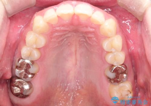 全体のガタガタをインビザラインできれいな歯並びへの治療後