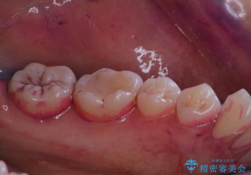 歯科矯正前にPMTCで清潔な口腔内にの治療前