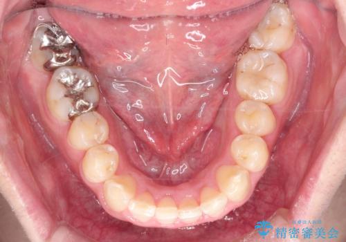 全体のガタガタをインビザラインできれいな歯並びへの治療後