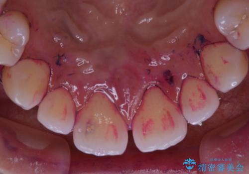 歯科矯正前にPMTCで清潔な口腔内にの治療前