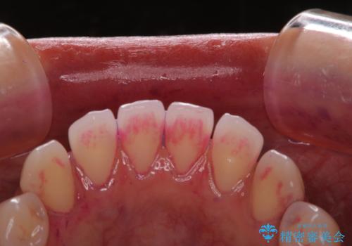 歯科矯正前にPMTCで清潔な口腔内にの治療前