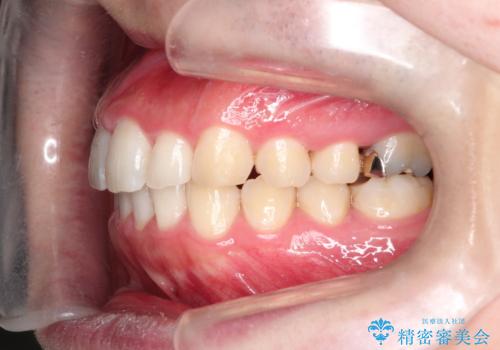 全体のガタガタをインビザラインできれいな歯並びへの治療後