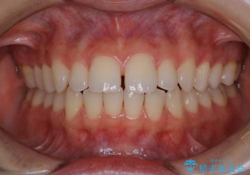 歯科矯正前にPMTCで清潔な口腔内にの治療後