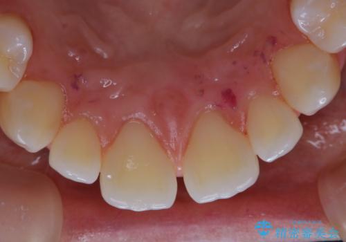 歯科矯正前にPMTCで清潔な口腔内にの治療後