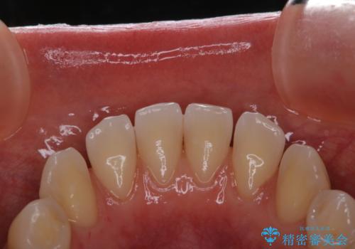 歯科矯正前にPMTCで清潔な口腔内にの治療後