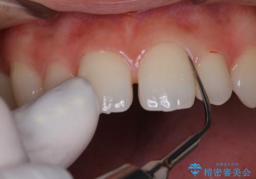 歯科矯正前にPMTCで清潔な口腔内にの治療中