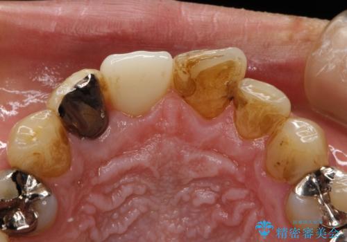 ステインにより見つかりにくい虫歯の症例 治療前