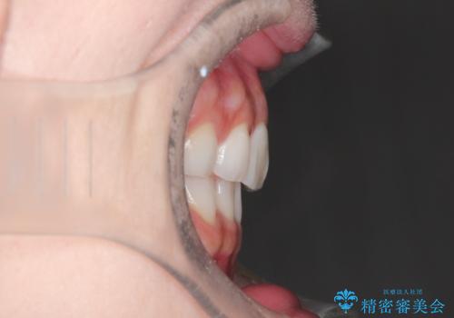 口が閉じにくい 口ゴボの抜歯矯正による改善の治療後