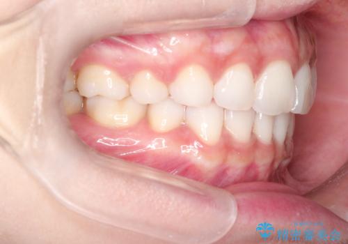口が閉じにくい　口ゴボの抜歯矯正による改善の症例 治療後