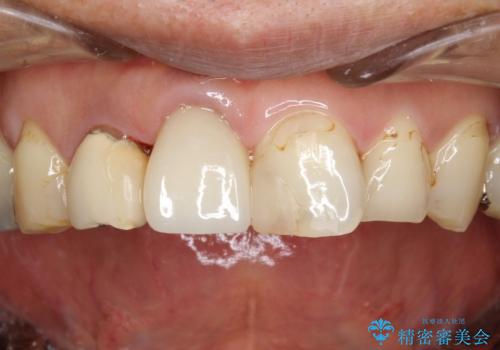 ステインにより見つかりにくい虫歯の治療後