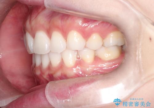 口が閉じにくい 口ゴボの抜歯矯正による改善の治療後