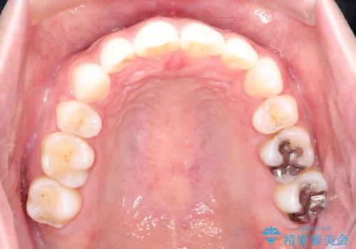 口が閉じにくい 口ゴボの抜歯矯正による改善の治療後