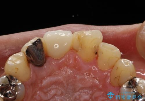 ステインにより見つかりにくい虫歯の症例 治療後