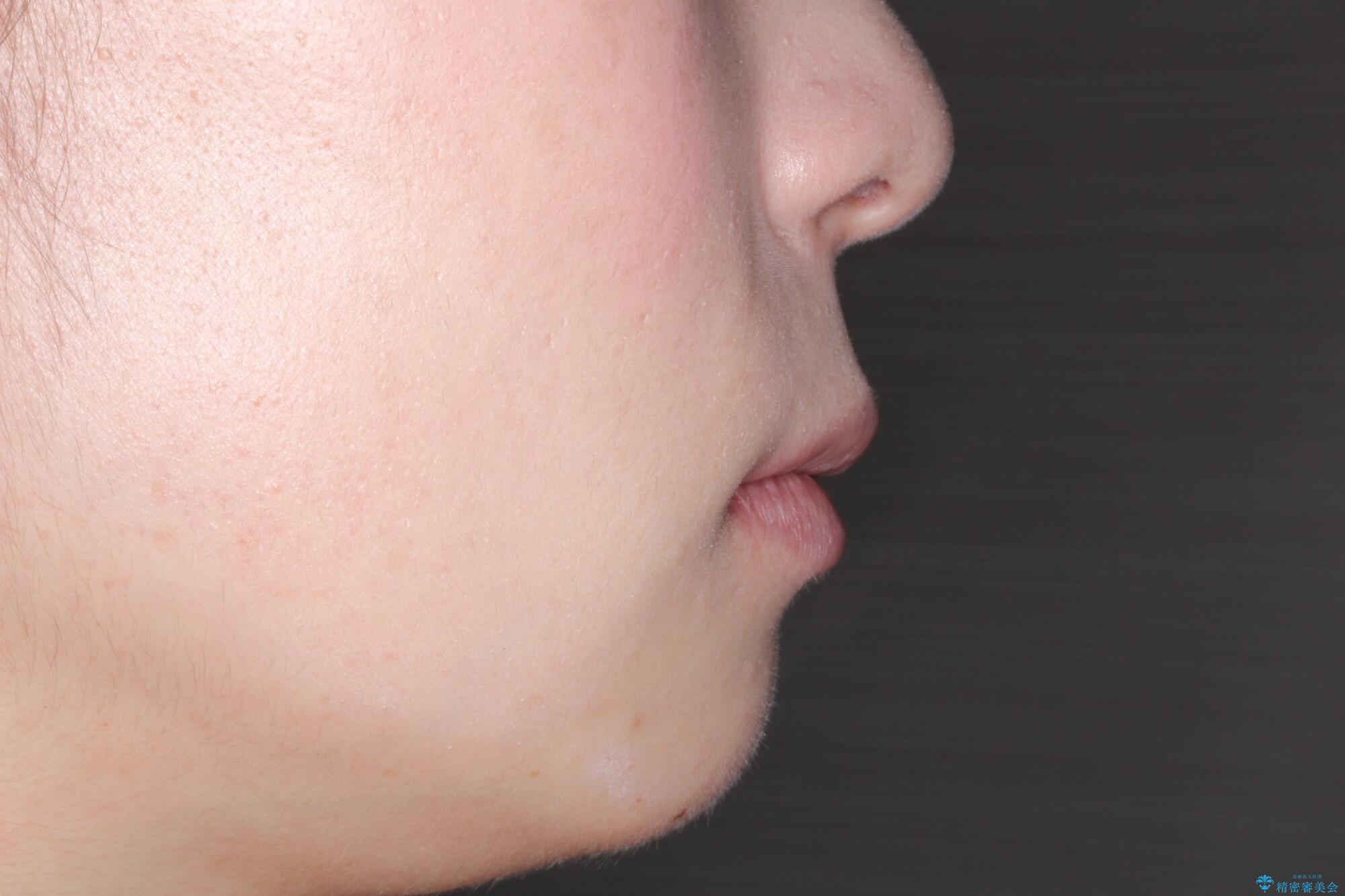 口が閉じにくい　口ゴボの抜歯矯正による改善の治療後（顔貌）