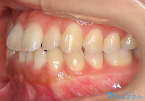 前歯のがたつき インビザラインで 下の奥歯を後ろに下げるの治療前