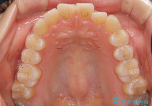 前歯のがたつき インビザラインで 下の奥歯を後ろに下げるの治療前
