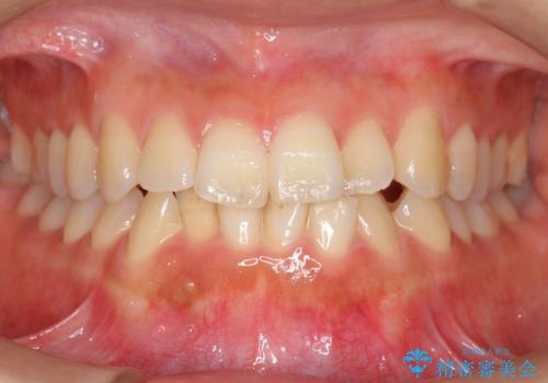 前歯のがたつき　インビザラインで　下の奥歯を後ろに下げるの症例 治療前