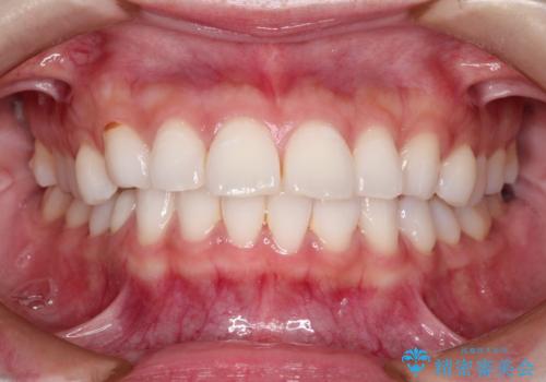 口が閉じにくい 口ゴボの抜歯矯正による改善の治療前