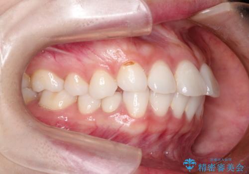 口が閉じにくい　口ゴボの抜歯矯正による改善の治療前