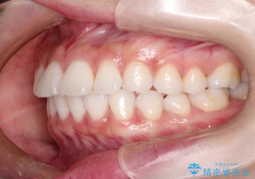 口が閉じにくい 口ゴボの抜歯矯正による改善の治療前