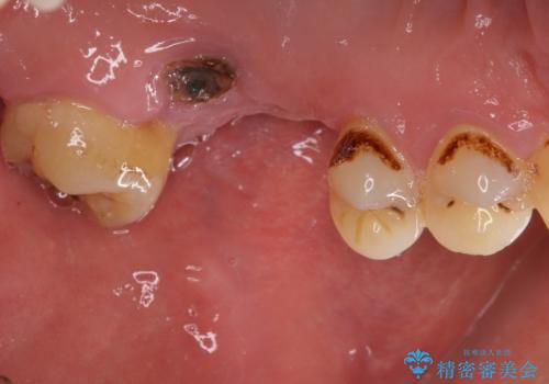 とにかく作り物のような真っ白な歯にしたい　フルジルコニアクラウンによる補綴治療の治療前