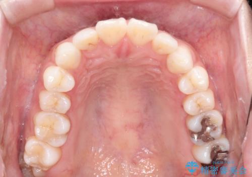 口が閉じにくい 口ゴボの抜歯矯正による改善の治療前