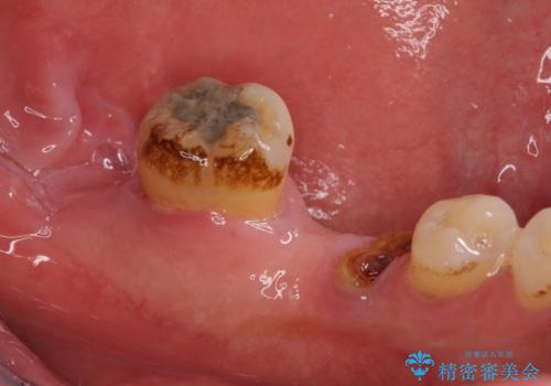 とにかく作り物のような真っ白な歯にしたい フルジルコニアクラウンによる補綴治療の治療前