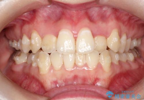 前歯が前後反対にかんでいる　インビザラインによる矯正の治療中