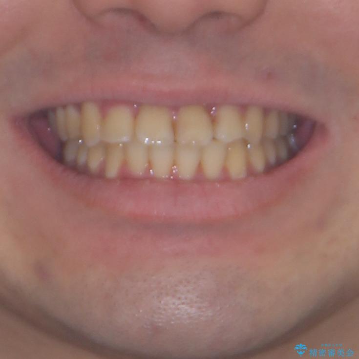 歯列全体のクロスバイトを治したい　ワイヤー装置による矯正治療の治療後（顔貌）