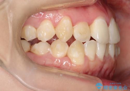 前歯が前後反対にかんでいる インビザラインによる矯正の治療中