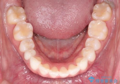 口が閉じにくい 口ゴボの抜歯矯正による改善の治療前