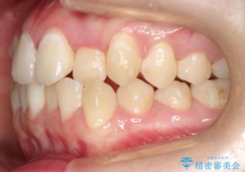 前歯が前後反対にかんでいる　インビザラインによる矯正の治療中
