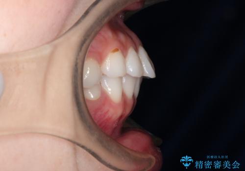 口が閉じにくい　口ゴボの抜歯矯正による改善の治療前