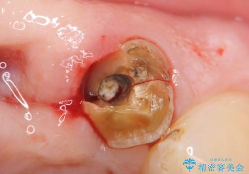 転んで前歯が2本ぬけた 自然なブリッジへ 60代男性の治療前