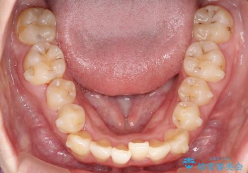 前歯が前後反対にかんでいる インビザラインによる矯正の治療中