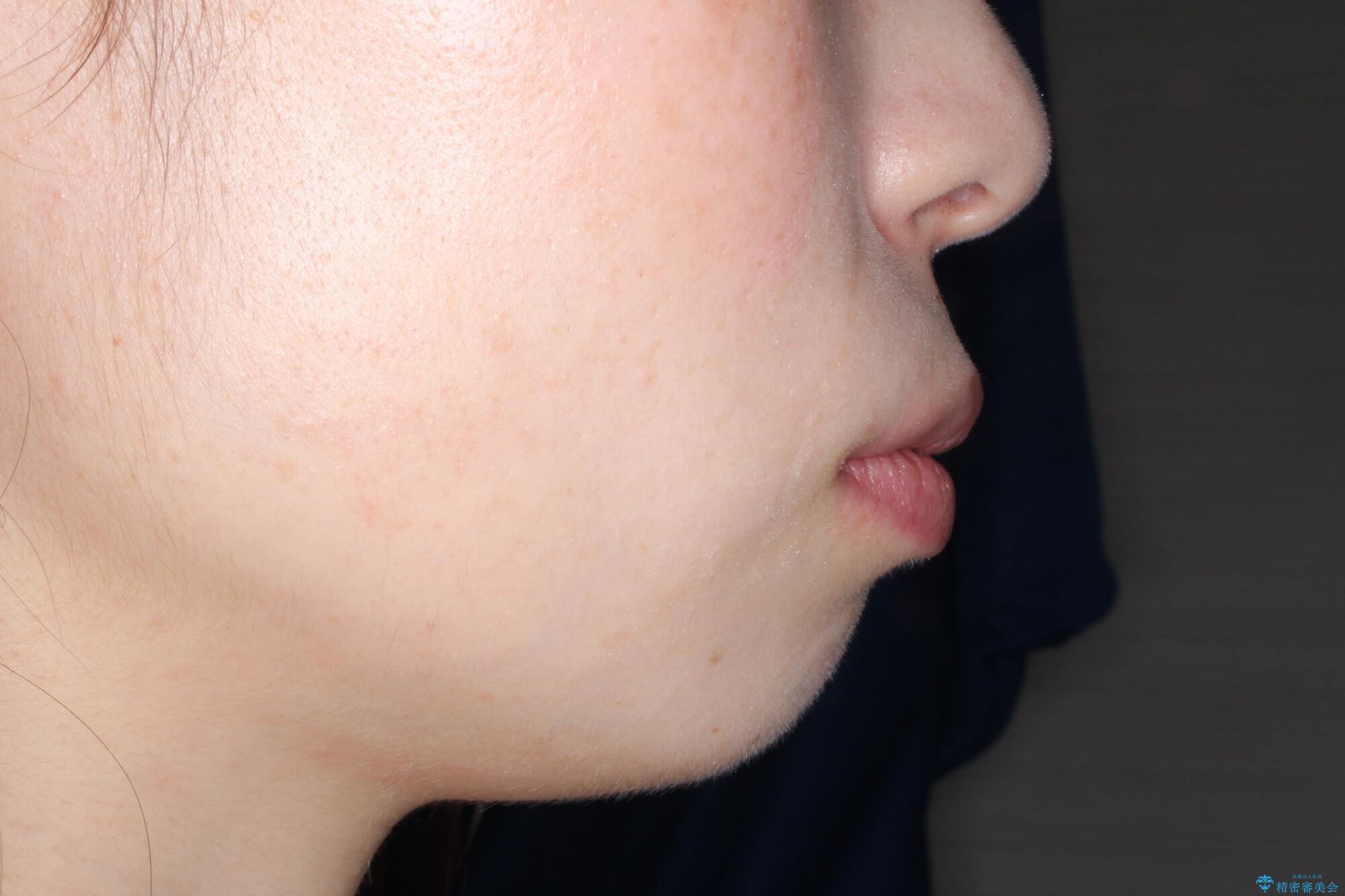 口が閉じにくい 口ゴボの抜歯矯正による改善の治療前(顔貌)