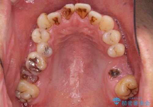 とにかく作り物のような真っ白な歯にしたい フルジルコニアクラウンによる補綴治療の治療前