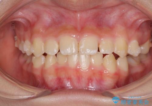 遠方から新幹線で通院 急速拡大装置とインビザラインによる矯正治療の治療中