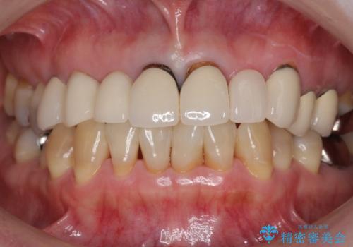 前歯のブリッジの下が虫歯 ブリッジのやりかえの症例 治療前