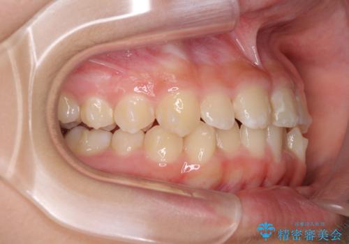 遠方から新幹線で通院 急速拡大装置とインビザラインによる矯正治療の治療中