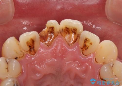 とにかく作り物のような真っ白な歯にしたい フルジルコニアクラウンによる補綴治療の治療前