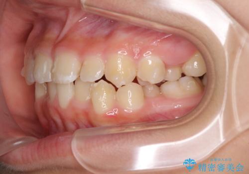 遠方から新幹線で通院 急速拡大装置とインビザラインによる矯正治療の治療中