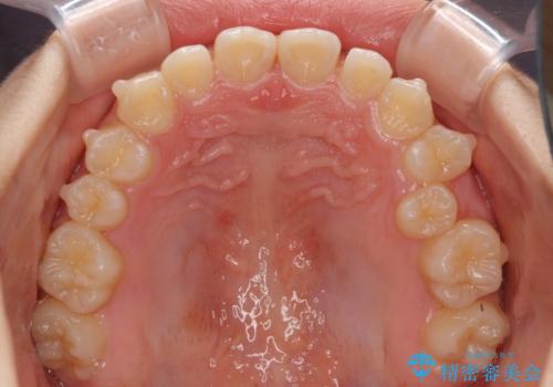 遠方から新幹線で通院 急速拡大装置とインビザラインによる矯正治療の治療中