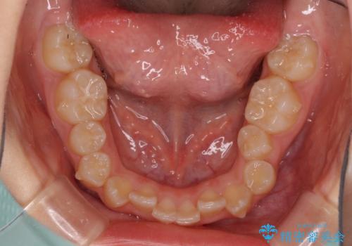 遠方から新幹線で通院 急速拡大装置とインビザラインによる矯正治療の治療中