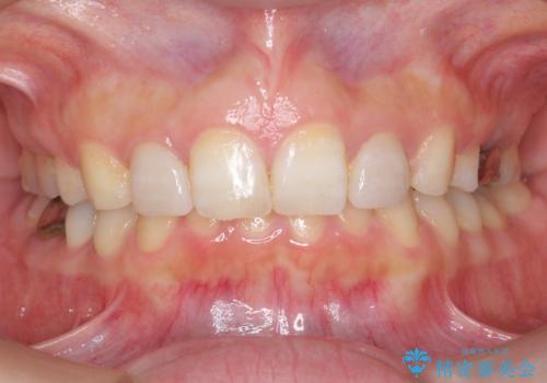 出っ歯を治したい 過蓋咬合の治療後