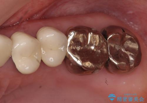 奥歯の被せ物のやり直し　精密根管治療の症例 治療前
