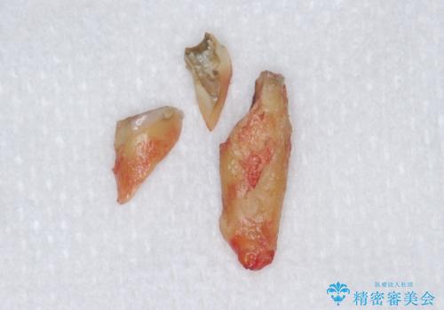 転んで前歯が2本ぬけた 自然なブリッジへ 60代男性の治療中