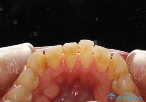 歯磨き中に血が出る　PMTCで歯石除去の治療前