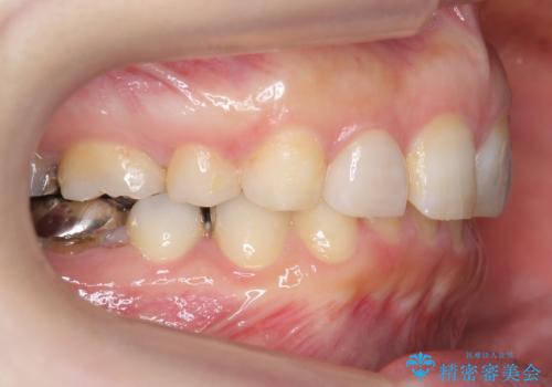 出っ歯を治したい　過蓋咬合の治療後